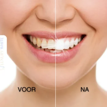 New Luxury White Whitening Strips